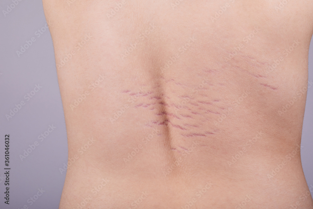 Close up view of the back with striae distensae (striae rubrae) on the  skin. The concept of impaired skin elasticity during puberty Stock Photo