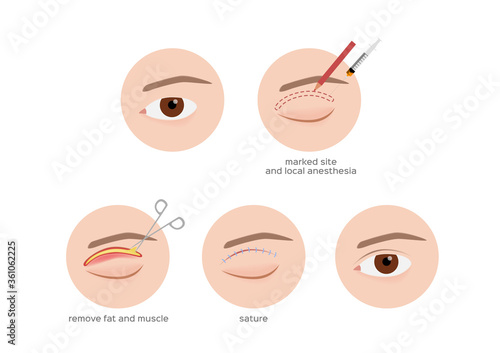 double eyelid surgery infographic step vector / cosmetic surgery on white background