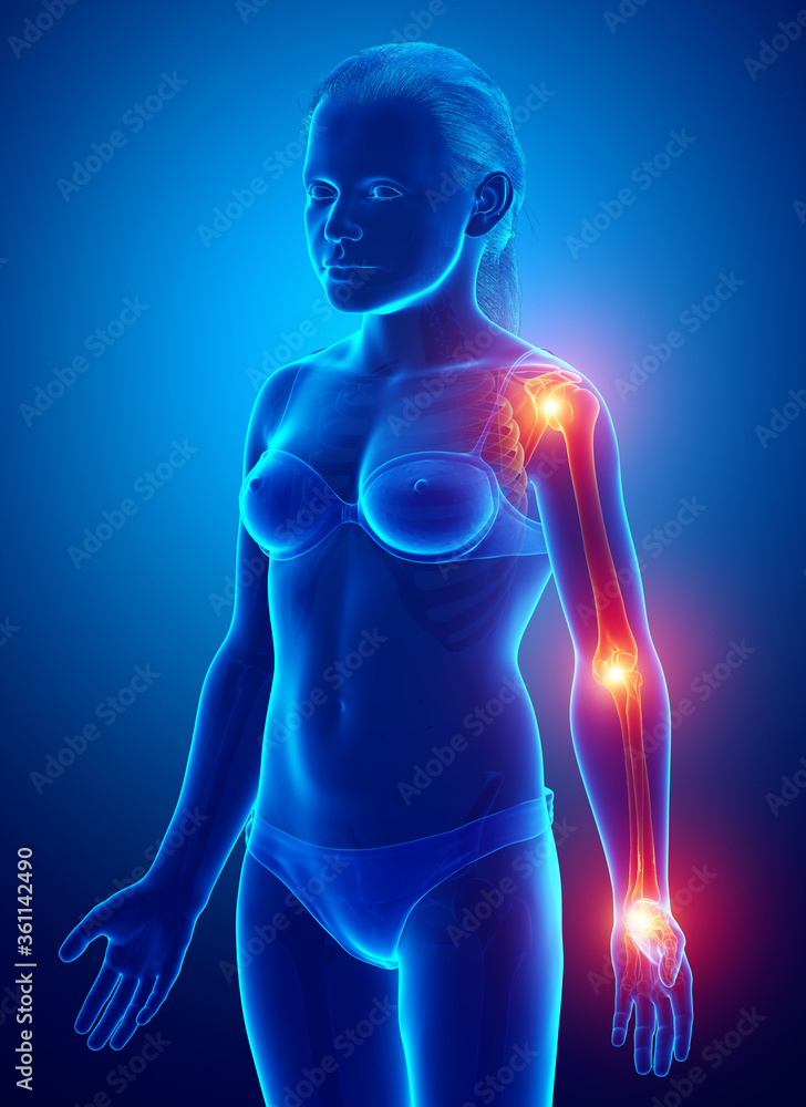 3d Illustration of young girl arm joint pain 3d Illustration of young girl arm joint pain