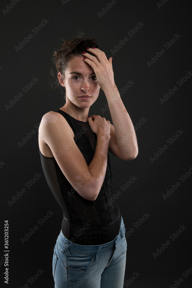Vitiligo on the hands. Young beautiful woman with vitiligo. Vitiligo on the hands. Young beautiful woman with vitiligo.