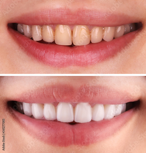 Perfect smile before and after bleaching procedure whitening of young happy smiling woman . Dental restoration treatment clinic patient.Demonstration result of oral care dentistry, stomatology..