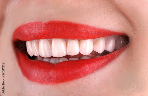 Perfect healthy teeth beautiful wide smile bleaching procedure whitening of young smiling attractive sexy red lips woman. Dental restoration treatment Close Up oral care, stomatology Dentistry