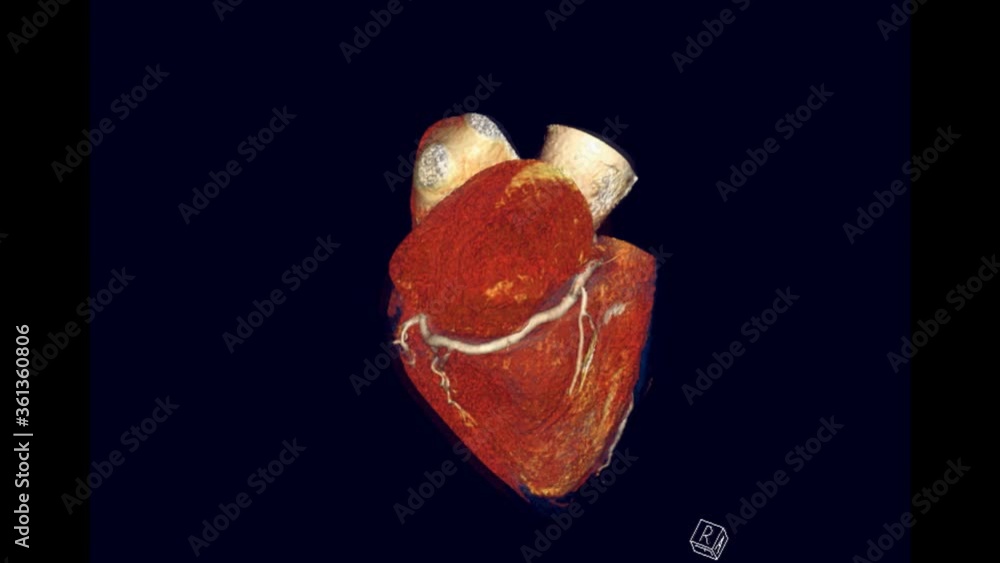 CTA Coronary Artery 3D rendering image showing heart and vessel ...
