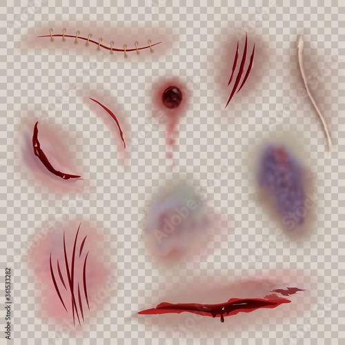Bloody wounds. Realistic various scars, wound and stitch. Slaughter, torn gash and bruise, surgery or halloween texture. Vector isolated set on transparent background