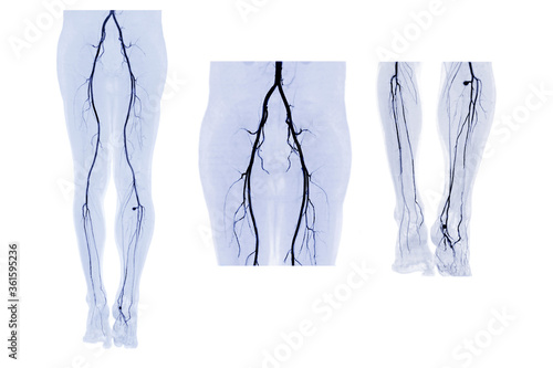 Canvas Print Collection of CTA femoral artery run off  3D MIP image.