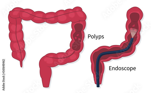 Flat vector illustration of colorectal cancer screening. Colonoscopy endoscopic examination of the large bowel. Removing polyps procedure.