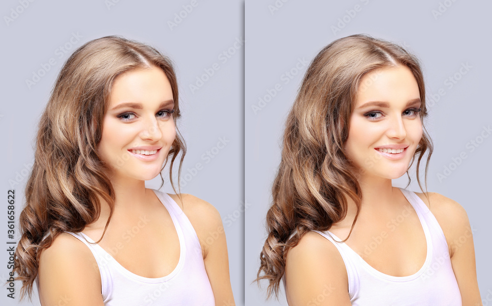 Rhinoplasty.Before and after Rhinoplasty.Before and after