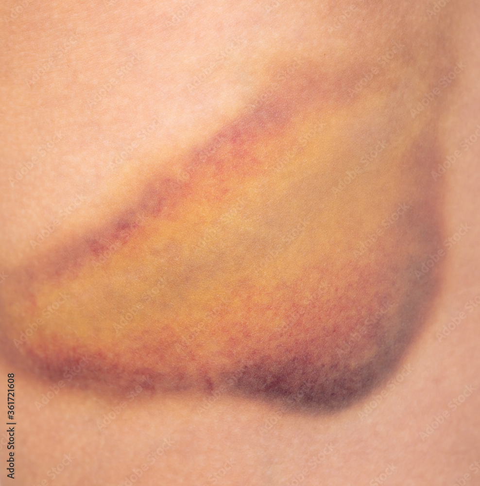 Closeup bruise on human skin as a background.