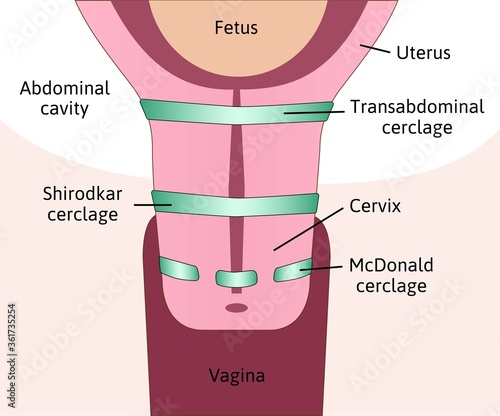 three types of Cervical cerclage or cervical stitch, treatment for cervical weakness. Transabdominal, Shirodkar and McDonald cerclage. Fetus in womb, uterus. Colored medical vector illustration.