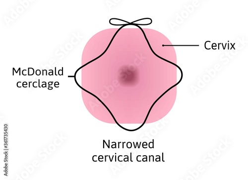 McDonald cerclage tightening of cervix opening during pregnancy. Anatomy of cervical canal. cervix weakness and black cerclage on it. vector illustration marked with lines. Medical drawing isolated photo