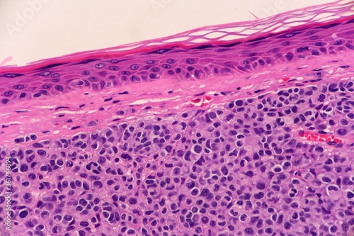 фотографія A malignant skin cancer called nodular melanoma, just beneath the epidermis