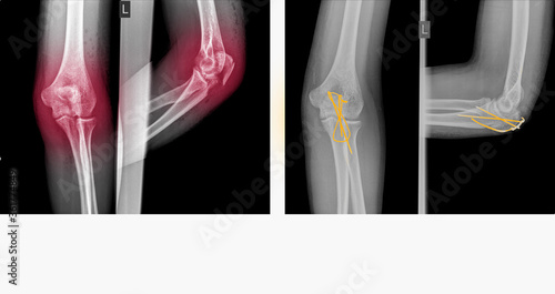 X-ray elbow showing fracture (proximal Ulna or Olecranon fracture) treated by surgery with tension band wiring fixation(TBW). Highlight on medical instrument.Medical healthcare concept. photo