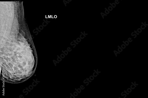 Special Mammogram Image (CMediolateral oblique - MLO)Examination in Women Over the age of 40 -Left Breast.Medical checkup image concept.