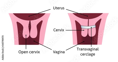 Cervical cerclage tightening of cervical opening during pregnancy. problem, injury. uterus with open cervix and light blue cerclage on it. vector illustration marked with lines. Medical.
