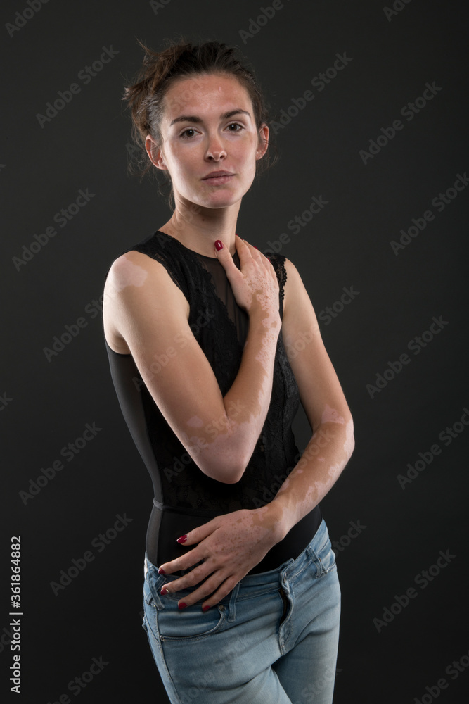 Portrait of beautiful woman with vitiligo.