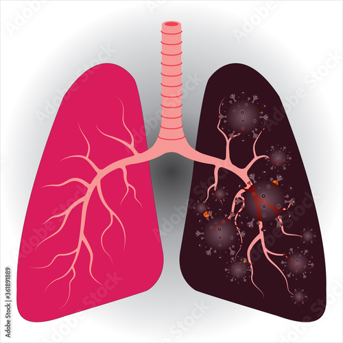Compare between normal healthy lung and coronavirus lung damage vector illustration isolated on white background.