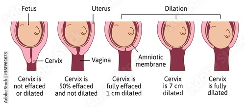Cervical effacement and dilation during labor or delivery. Cervix changes from not effaced and dilated to fully effaced and totally dilated. Vector medical illustration photo