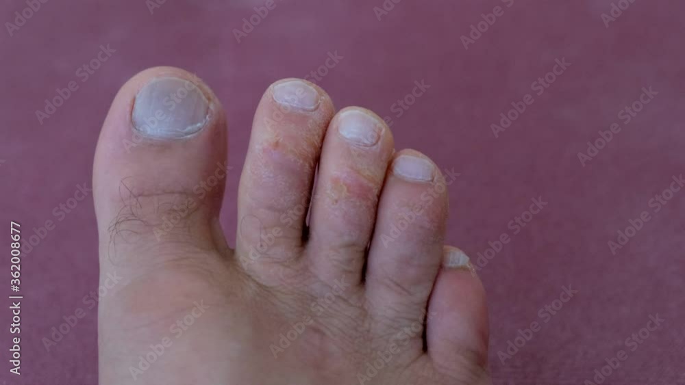 callus formed on the toes, callus formed on the toes, callus formed on the toes, callus formed on the toes,