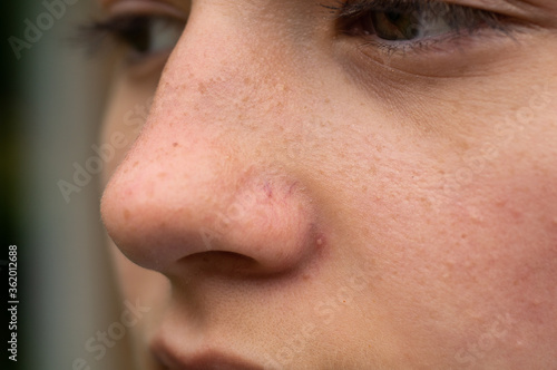 A close-up portrait of a teen girl showing redness and inflamed blood vessels on her nose