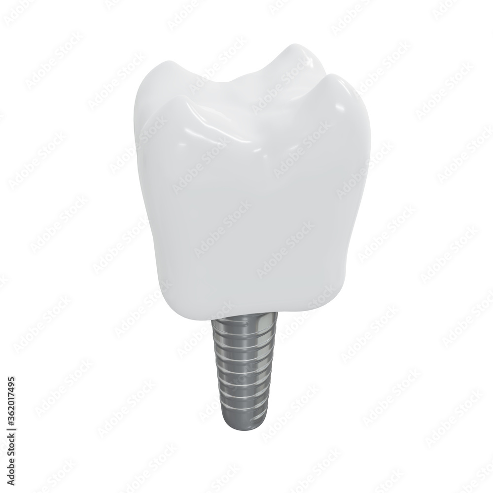 Dental Implants surgery concept, dentistry denture, Dental denture on white background. 3D render. Dental Implants surgery concept, dentistry denture, Dental denture on white background. 3D render.