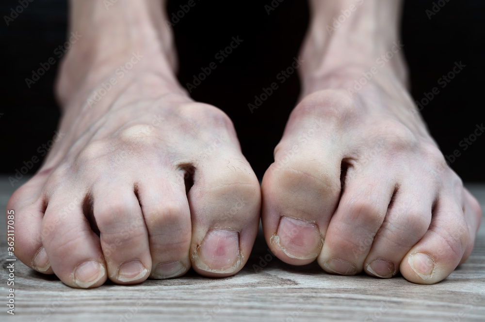 scary dirty thin feet with sore, tucked fingers from constraint by ingrown nails