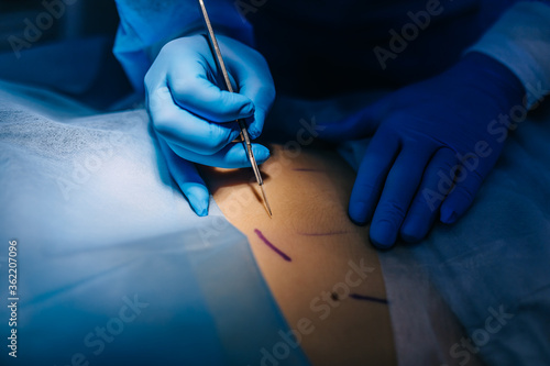 Surgeon preparing to make an incision with a scalpel along a dotted line on the patients skin, close up of his gloved hands