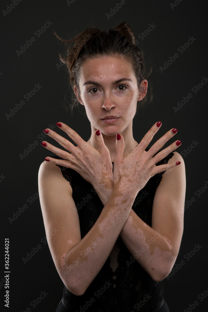 Portrait of beautiful woman with vitiligo. Portrait of beautiful woman with vitiligo.