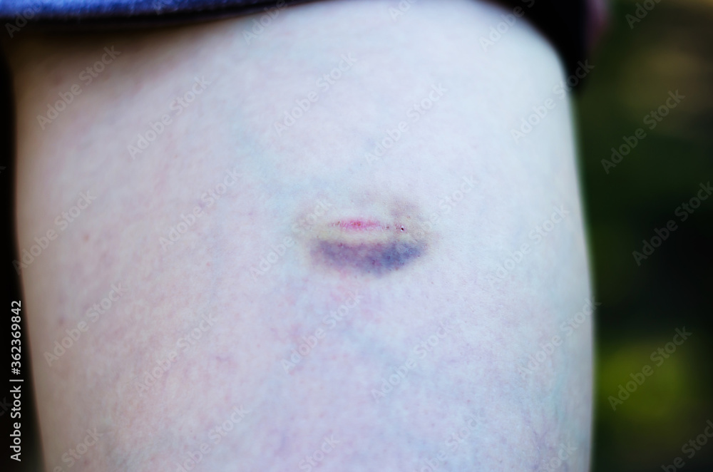 Fototapeta premium Close-up of a large bruise and scratch on a female foot. Photo for advertising medicines for bruises and bruises