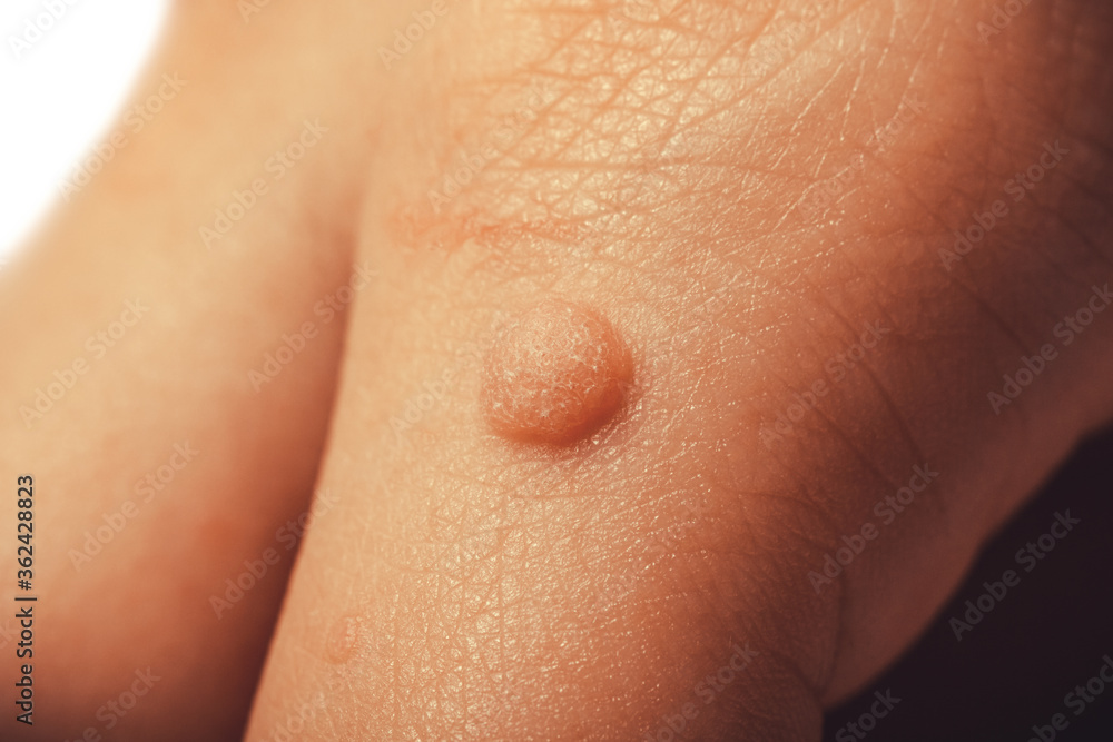 Common wart Verruca vulgaris a flat wart commonly found on the hand of children and adults. They are caused by a type of human papillomavirus HPV Common wart Verruca vulgaris a flat wart commonly found on the hand of children and adults. They are caused by a type of human papillomavirus HPV