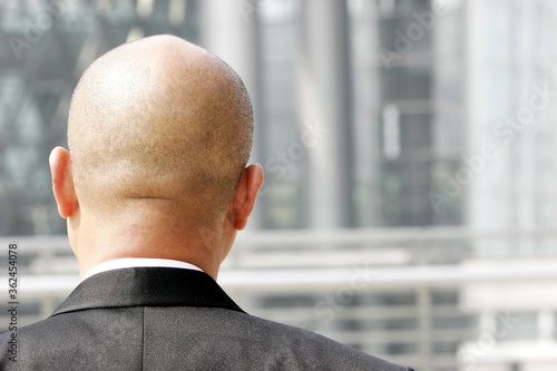 Back shot of a bald man's head