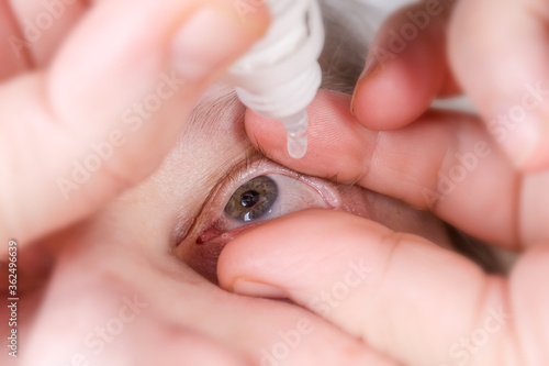Human eye during the dripping with eye drops, close-up