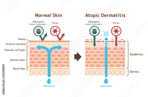 Sectional view of atopic dermatitis and normal skin / Comparative vector illustration