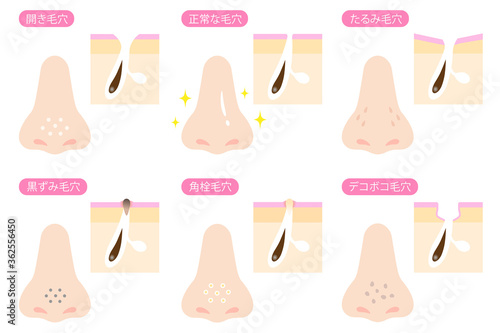 鼻と毛穴　肌の断面図　セット