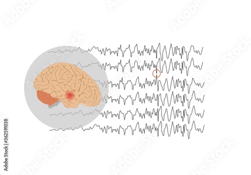 Focal seizure originating from temporal lobe photo