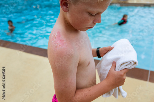 Canvas Print Close up of the sun burnt skin on a Young boy's shoulder