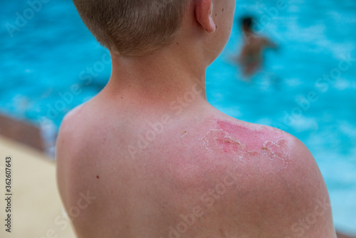 Close up of the sun burnt skin on a Young boy's shoulder. Selective focus on the dead peeling skin after a severe sunburn