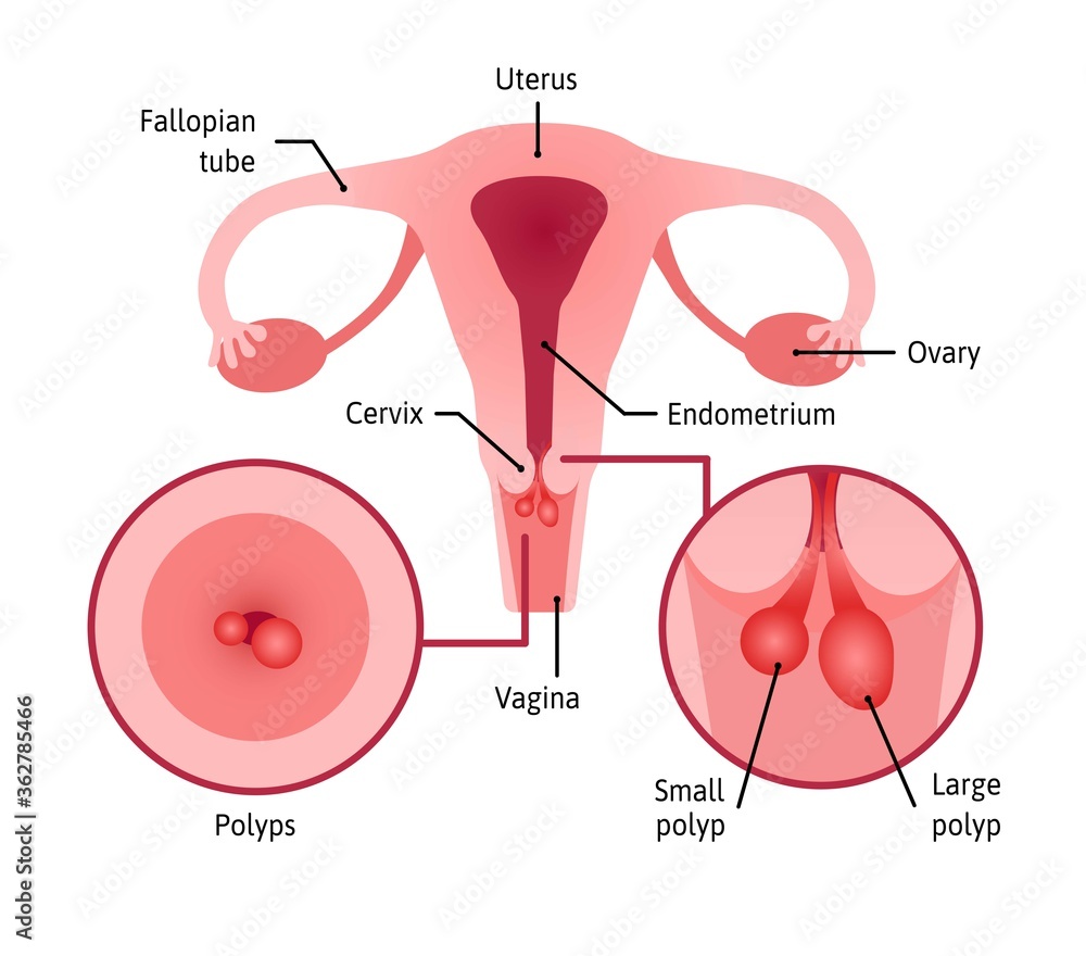 Obraz premium cervical polyps. Uterus with cervix marked with lines. Small and large polyps are shown in anterior view and inside. Medical vector illustration