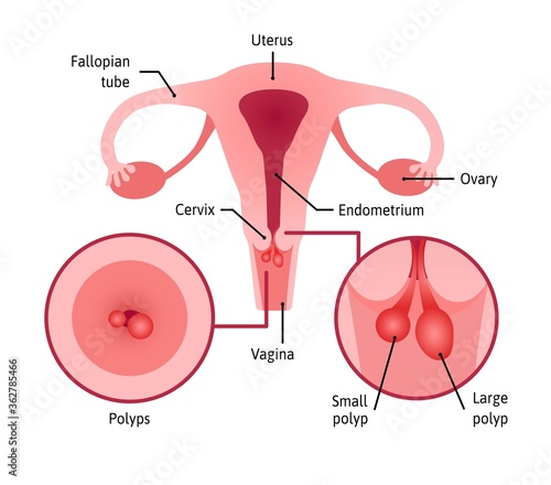 cervical polyps. Uterus with cervix marked with lines. Small and large polyps are shown in anterior view and inside. Medical vector illustration