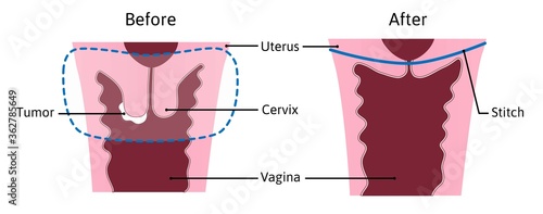 trachelectomy - surgery removal of the cervix. Medical vector illustration marked with lines. Before and after. Stitch, vagina, cervix, tumor, cancer