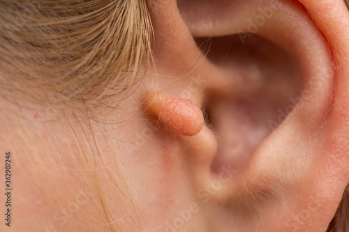  A congenital deformity. Benign neoplasms of the outer ear in a teenage girl. Congenital ear appendage