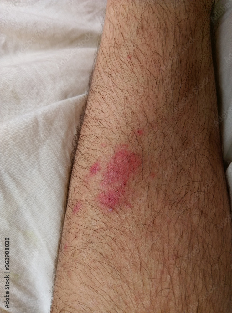 Arm Skin Allergy Arm Skin Allergy