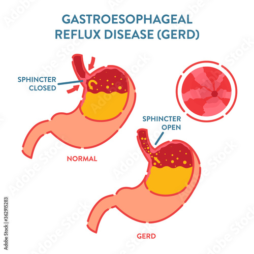 Gastroesophageal reflux disease diagnostics poster. Endoscopic image of stomach with GERD. Esophagus after acid reflux. Stomachs with open and closed sphincter. Medical concept vector illustration.  photo