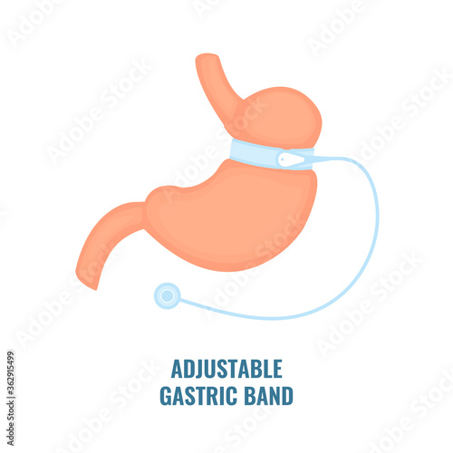 Stomach with adjustable gastric band device. Bariatric surgery weight loss procedure. Stomach reduction anatomical diagram infographic. Health care  medical concept. Vector illustration.