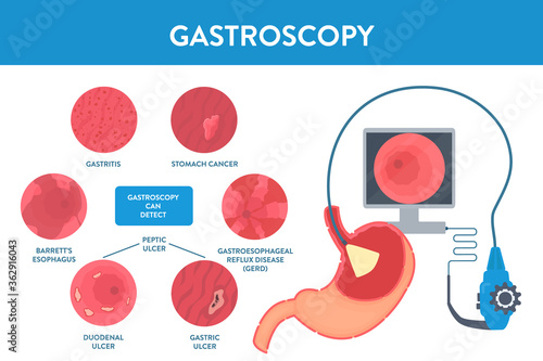 Stomach diseases and gastroscopy procedure equipment for diagnostics. Gastrointestinal tract examination. Medical concept. Vector illustration in flat style. Human body organ anatomy and health care.