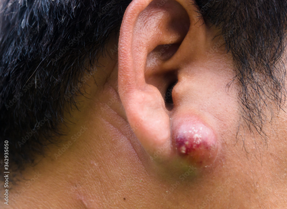 Close up of abscess Inflammation on the ear, area of suppuration