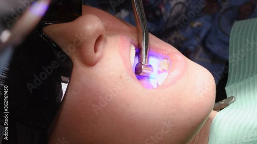 Applying resin based composite filling on tooth and curing it with LED. Young woman at dental clinic. Female dentist with assistant treating cavities in a patient mouth in modern dental office.