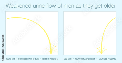 Strong urine stream of young man with healthy prostate and stream of old man with enlarged prostate in comparison. Weakened urinary flow of men as they get older. Vector illustration. 