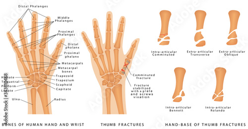 Thumb Fractures. Human hand bones anatomy. Hand - Base of Thumb Fractures. Displaced Fracture and Fracture without displacement. 