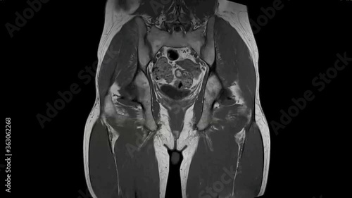 Osteonecrosis of the hips, MRI scan photo