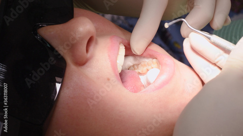 Applying resin based composite filling on tooth. Young woman at dental clinic. Female dentist with assistant treating cavities in a patient mouth in modern dental office.